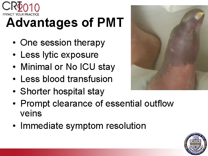 Advantages of PMT • • • One session therapy Less lytic exposure Minimal or