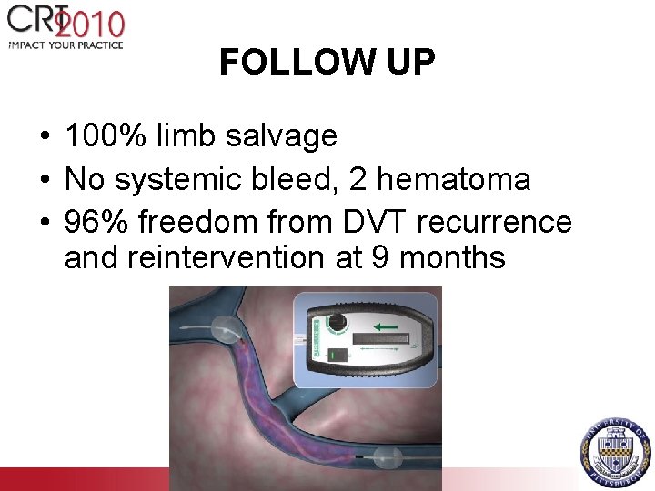 FOLLOW UP • 100% limb salvage • No systemic bleed, 2 hematoma • 96%