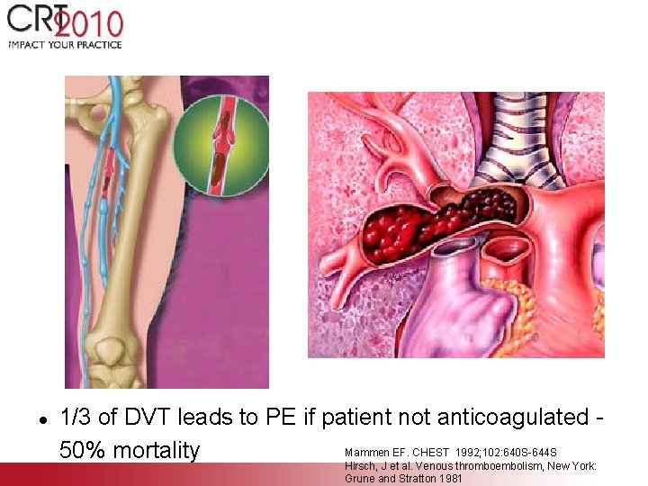 l 1/3 of DVT leads to PE if patient not anticoagulated Mammen EF. CHEST