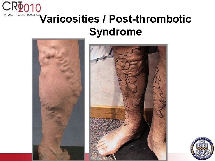 Varicosities / Post-thrombotic Syndrome 