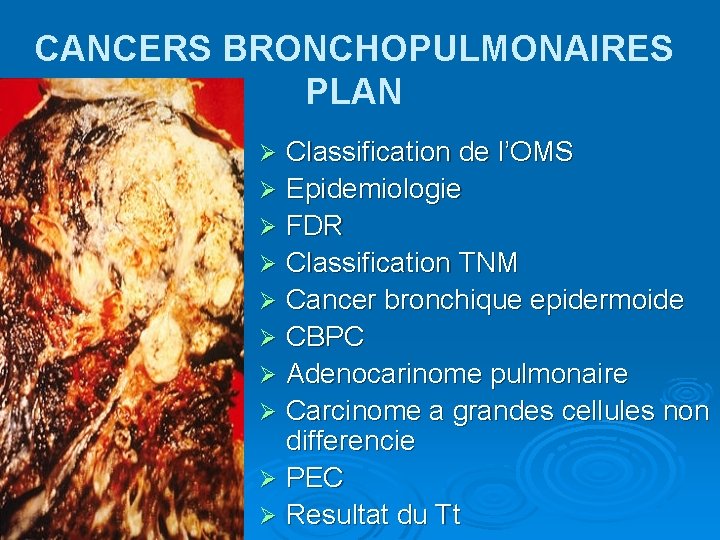 CANCERS BRONCHOPULMONAIRES PLAN Classification de l’OMS Ø Epidemiologie Ø FDR Ø Classification TNM Ø