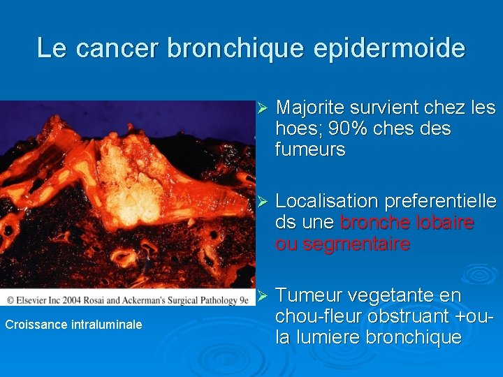 Le cancer bronchique epidermoide Croissance intraluminale Ø Majorite survient chez les hoes; 90% ches