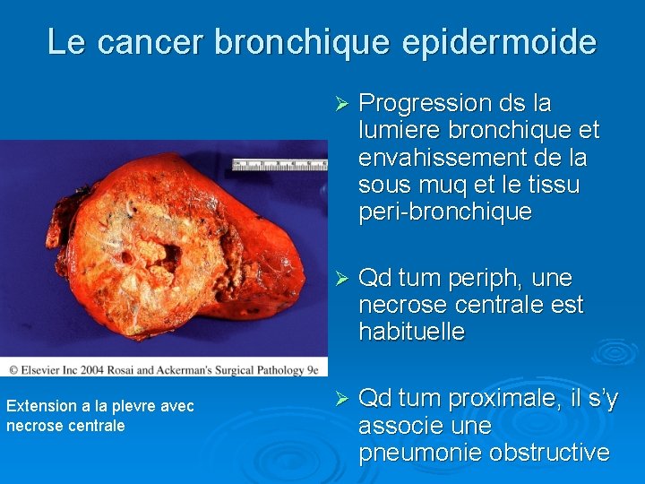 Le cancer bronchique epidermoide Extension a la plevre avec necrose centrale Ø Progression ds