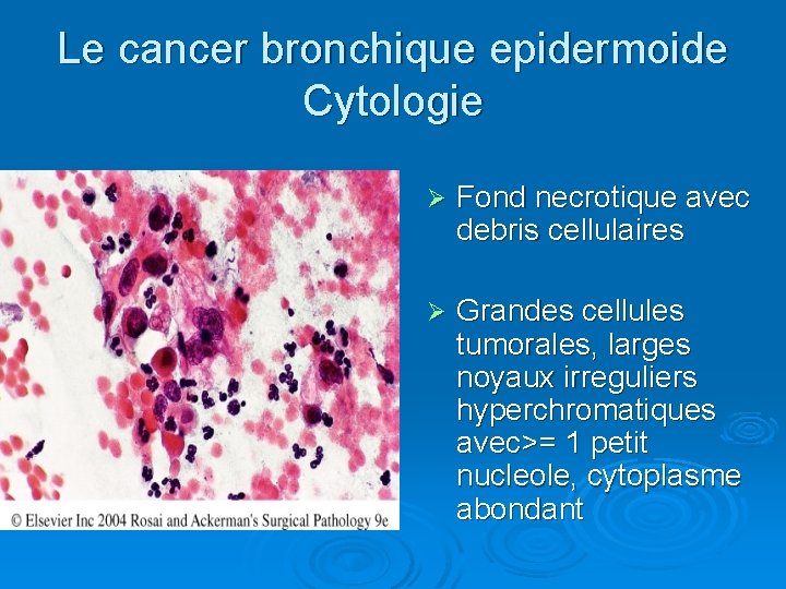 Le cancer bronchique epidermoide Cytologie Ø Fond necrotique avec debris cellulaires Ø Grandes cellules