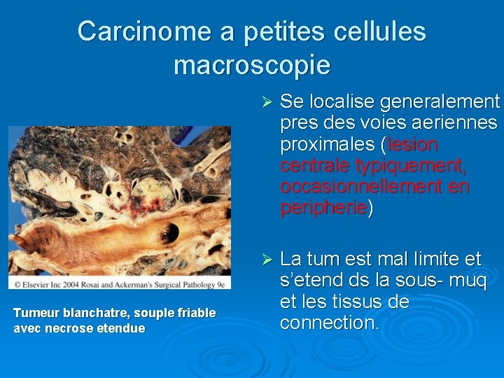 Carcinome a petites cellules macroscopie Tumeur blanchatre, souple friable avec necrose etendue Ø Se