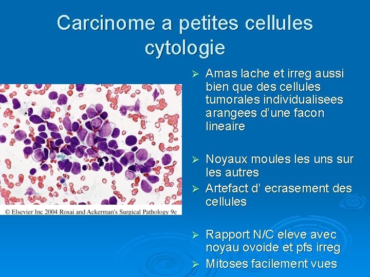 Carcinome a petites cellules cytologie Ø Amas lache et irreg aussi bien que des