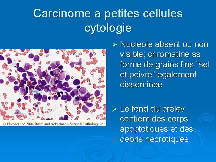 Carcinome a petites cellules cytologie Ø Nucleole absent ou non visible; chromatine ss forme