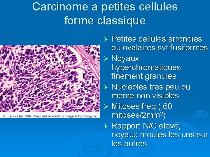 Carcinome a petites cellules forme classique Petites cellules arrondies ou ovalaires svt fusiformes Ø