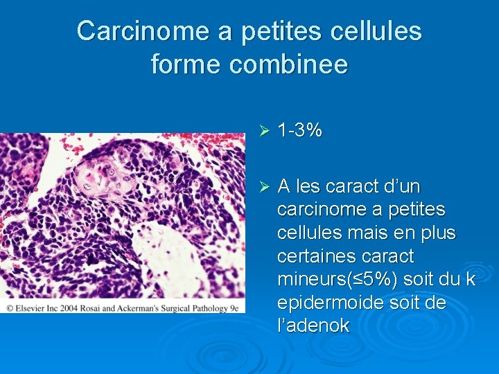 Carcinome a petites cellules forme combinee Ø 1 -3% Ø A les caract d’un