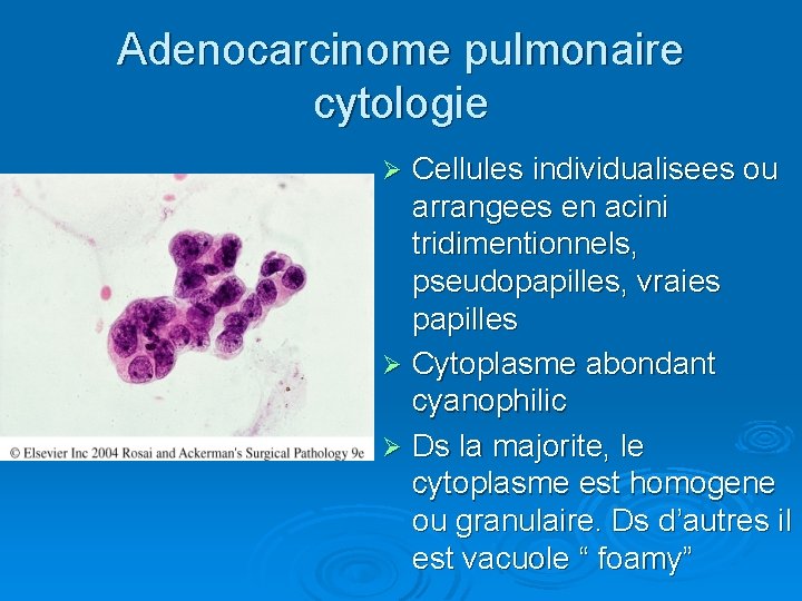 Adenocarcinome pulmonaire cytologie Cellules individualisees ou arrangees en acini tridimentionnels, pseudopapilles, vraies papilles Ø