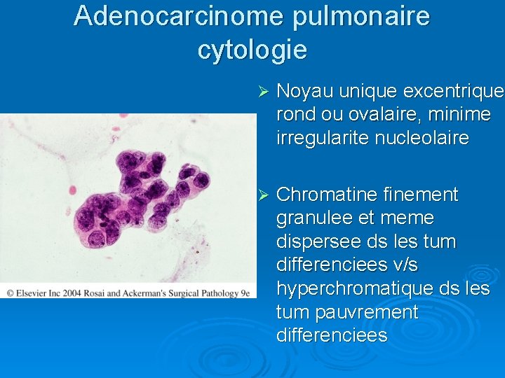 Adenocarcinome pulmonaire cytologie Ø Noyau unique excentrique, Noyau unique excentrique rond ou ovalaire, minime