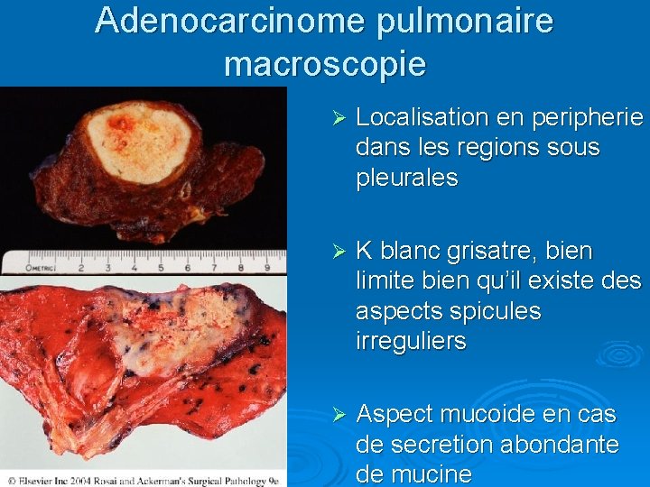 Adenocarcinome pulmonaire macroscopie Ø Localisation en peripherie dans les regions sous pleurales Ø K