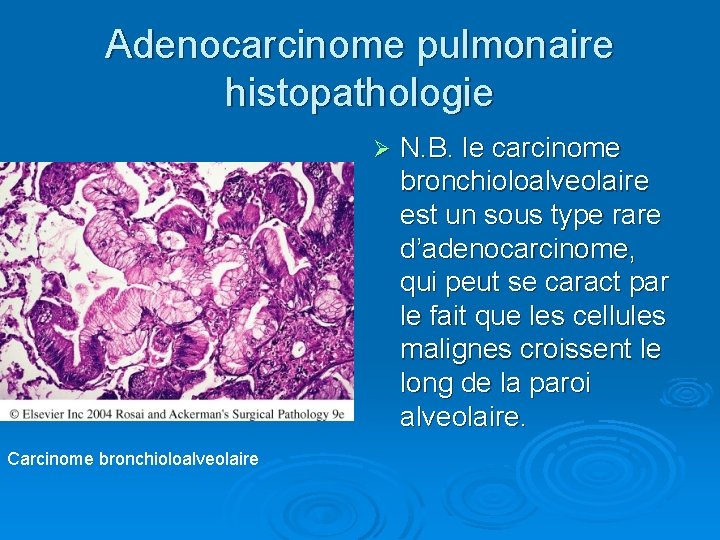 Adenocarcinome pulmonaire histopathologie Ø Carcinome bronchioloalveolaire N. B. le carcinome bronchioloalveolaire est un sous