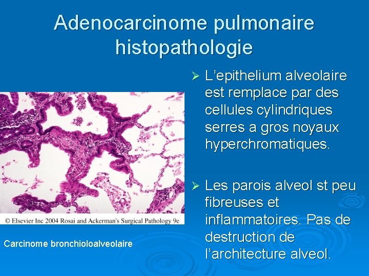 Adenocarcinome pulmonaire histopathologie Carcinome bronchioloalveolaire Ø L’epithelium alveolaire est remplace par des cellules cylindriques