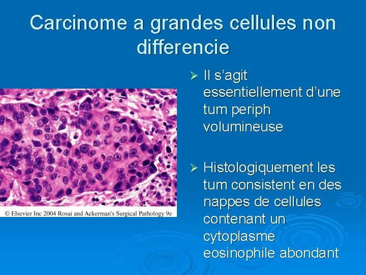 Carcinome a grandes cellules non differencie Ø Il s’agit essentiellement d’une tum periph volumineuse
