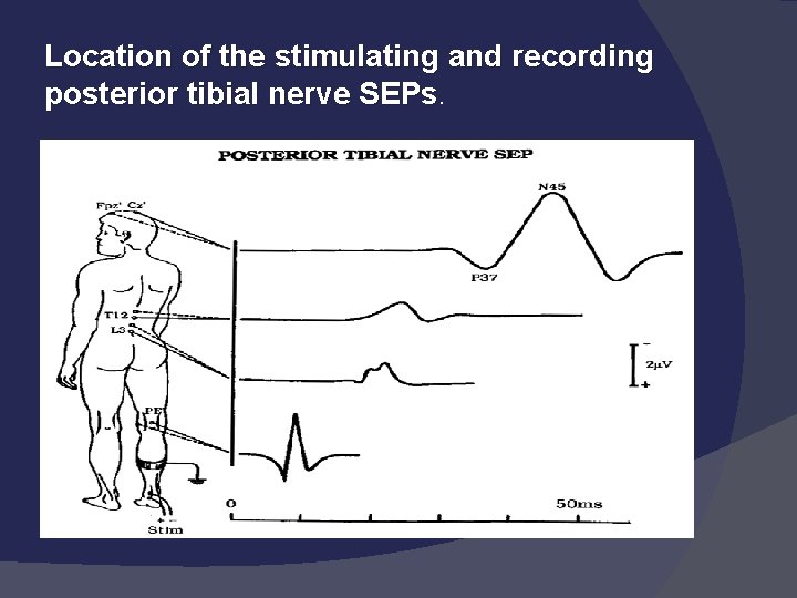 Location of the stimulating and recording posterior tibial nerve SEPs 