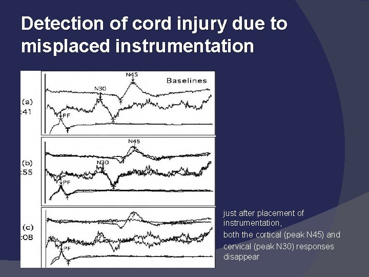 Detection of cord injury due to misplaced instrumentation � � � just after placement