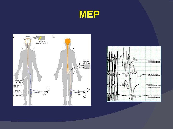 MEP 