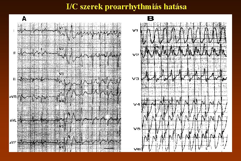 I/C szerek proarrhythmiás hatása 