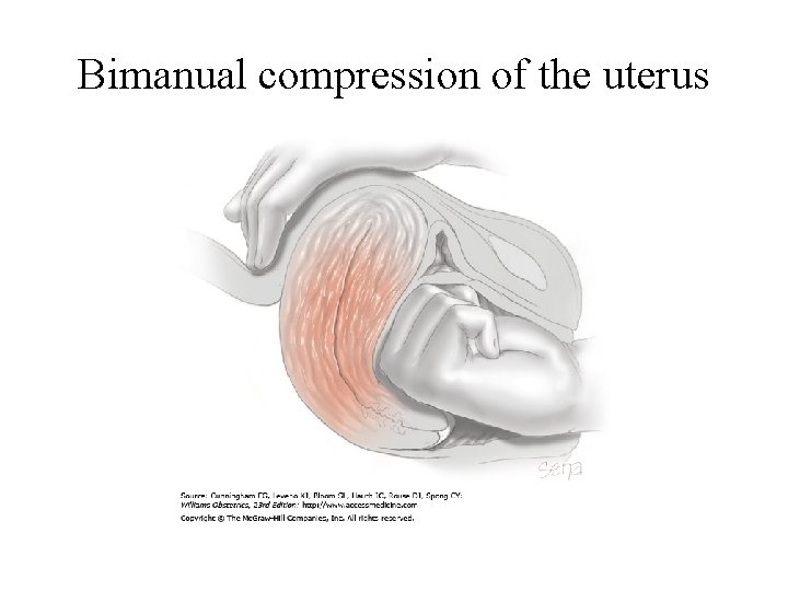 Bimanual compression of the uterus 