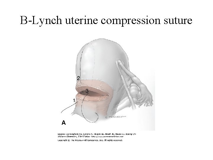 B-Lynch uterine compression suture 