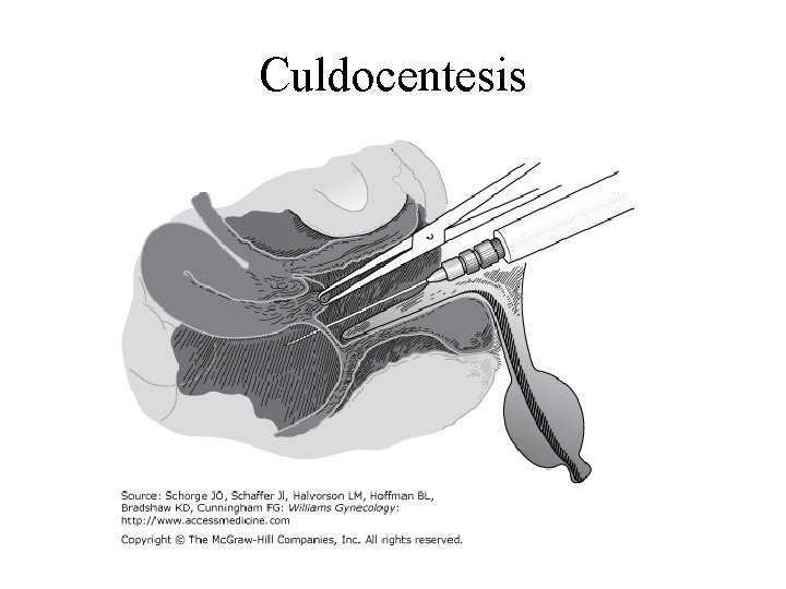 Culdocentesis 