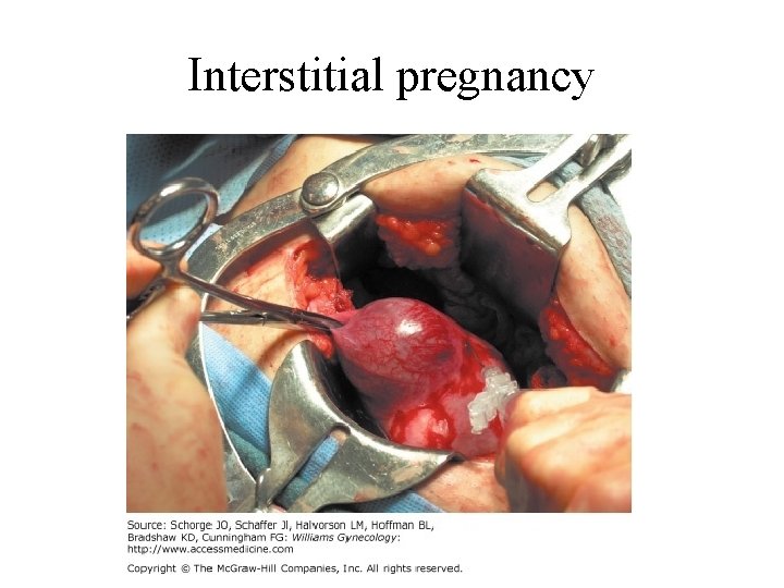 Interstitial pregnancy 