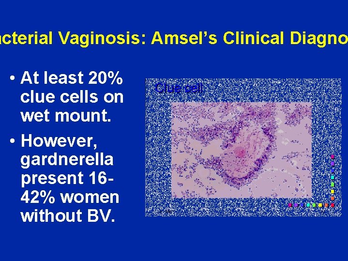 acterial Vaginosis: Amsel’s Clinical Diagno • At least 20% clue cells on wet mount.