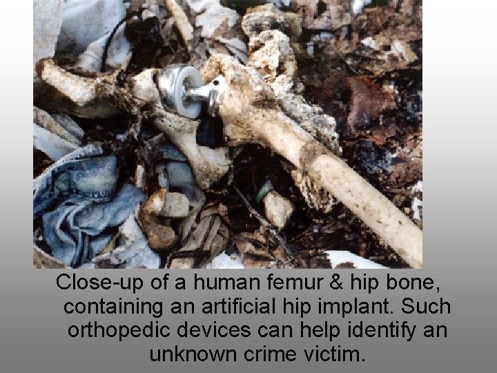 Close-up of a human femur & hip bone, containing an artificial hip implant. Such