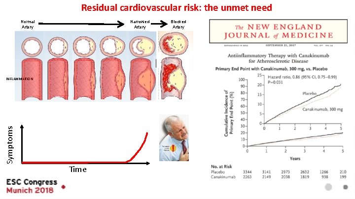 Residual cardiovascular risk: the unmet need Normal Artery Narrowed Artery Blocked Artery Symptoms INFLAMMATION