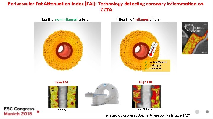 Perivascular Fat Attenuation Index (FAI): Technology detecting coronary inflammation on CCTA “Healthy, ” inflamed