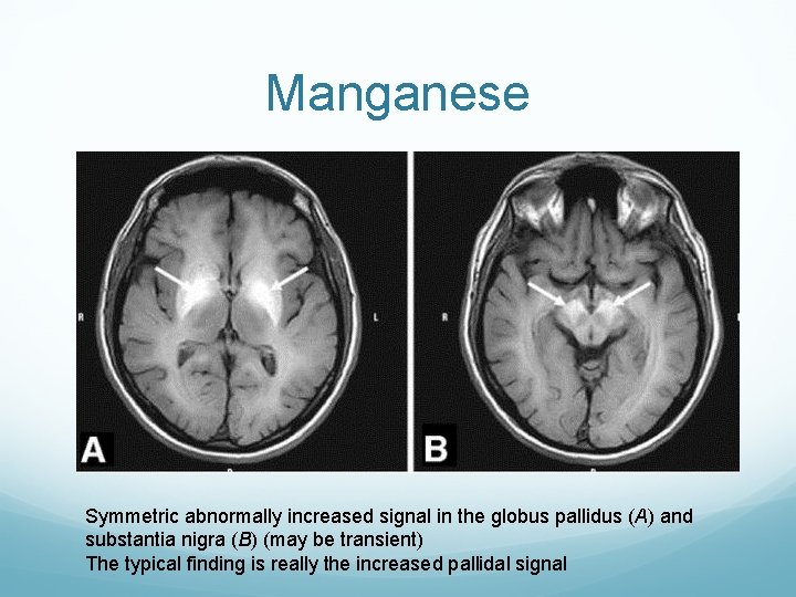 Manganese Symmetric abnormally increased signal in the globus pallidus (A) and substantia nigra (B)