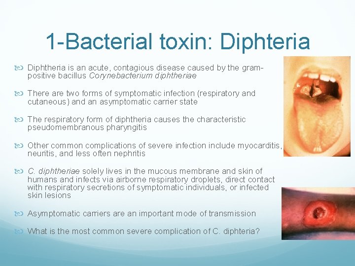 1 -Bacterial toxin: Diphteria Diphtheria is an acute, contagious disease caused by the grampositive