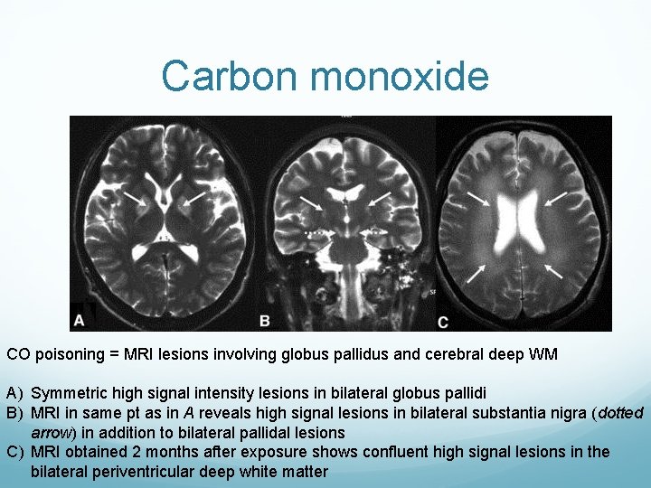 Carbon monoxide CO poisoning = MRI lesions involving globus pallidus and cerebral deep WM