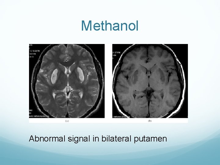 Methanol Abnormal signal in bilateral putamen 