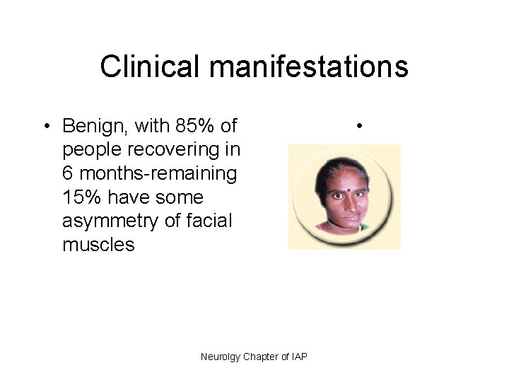 Clinical manifestations • Benign, with 85% of people recovering in 6 months-remaining 15% have