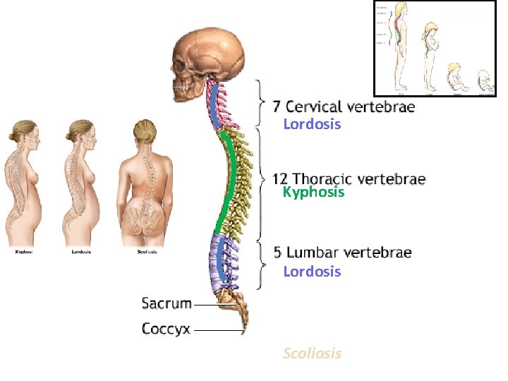 Lordosis Kyphosis Lordosis Scoliosis 