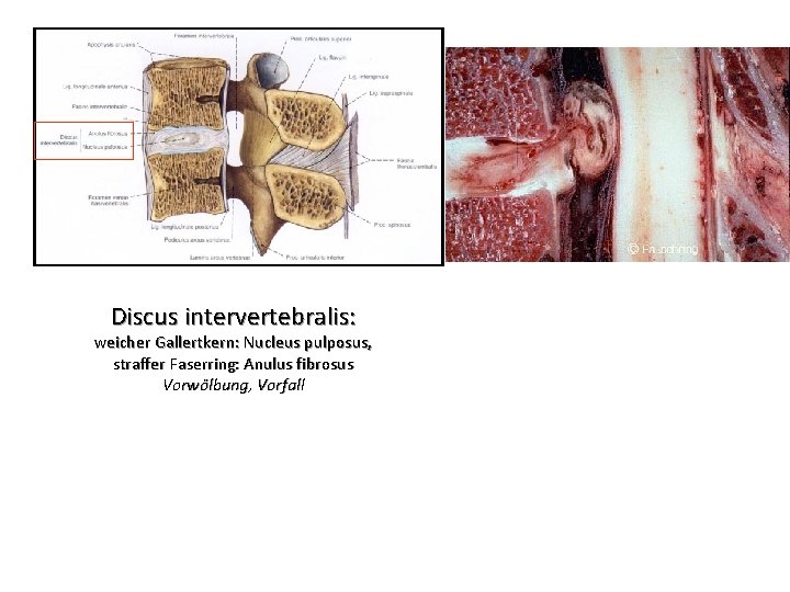 Discus intervertebralis: weicher Gallertkern: Nucleus pulposus, straffer Faserring: Anulus fibrosus Vorwölbung, Vorfall 