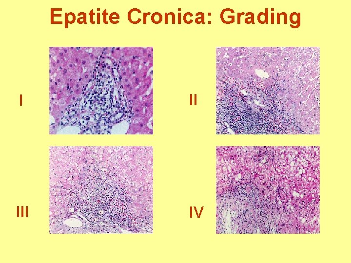 Epatite Cronica: Grading I II IV 