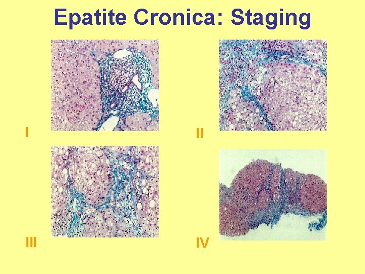 Epatite Cronica: Staging I II IV 