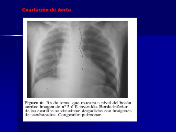 Coartacion de Aorta 