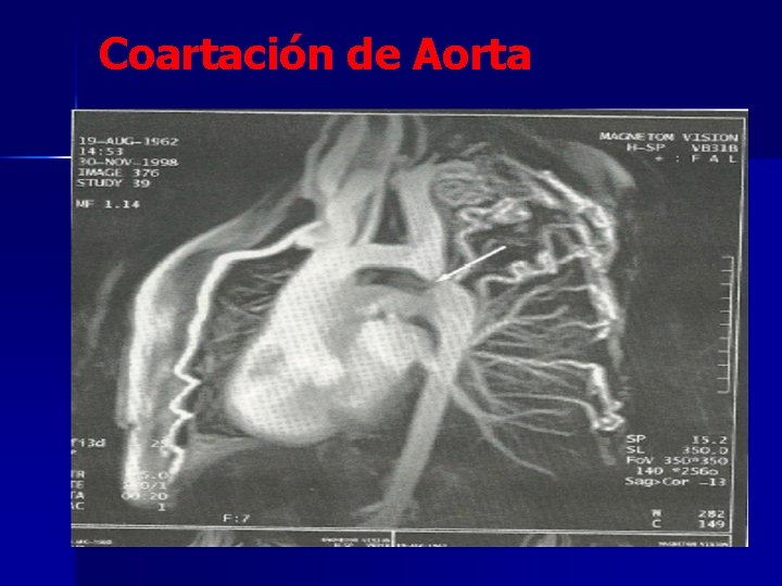 Coartación de Aorta 