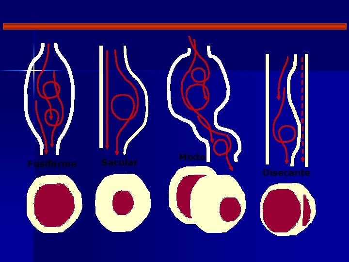 Fusiforme Sacular Mixto Disecante 