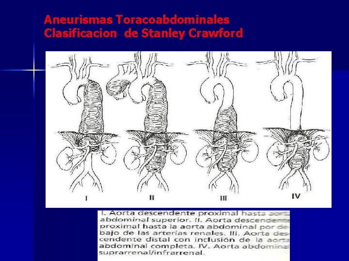 Aneurismas Toracoabdominales Clasificacion de Stanley Crawford 
