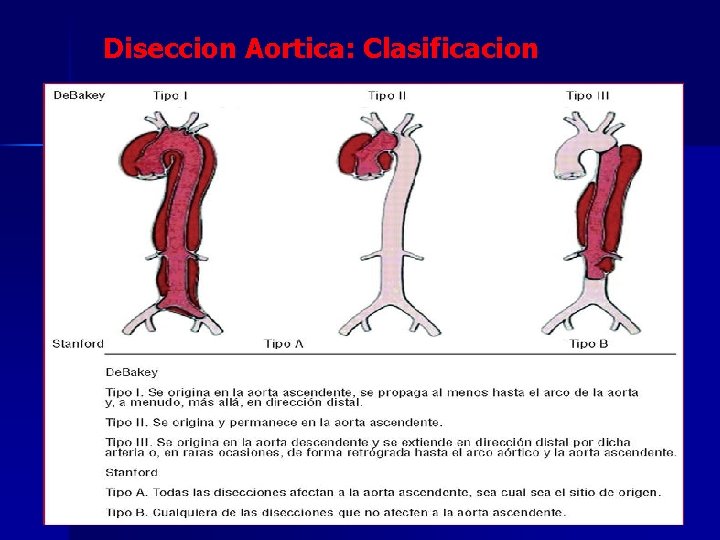 Diseccion Aortica: Clasificacion 