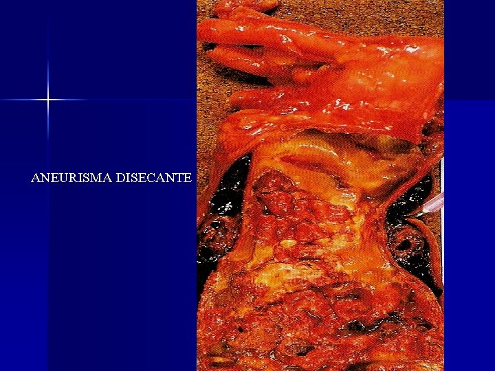 ANEURISMA DISECANTE 