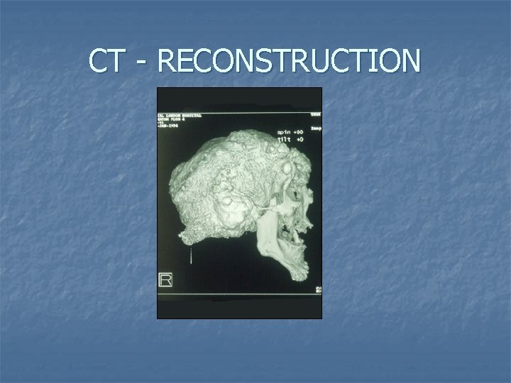 CT - RECONSTRUCTION 