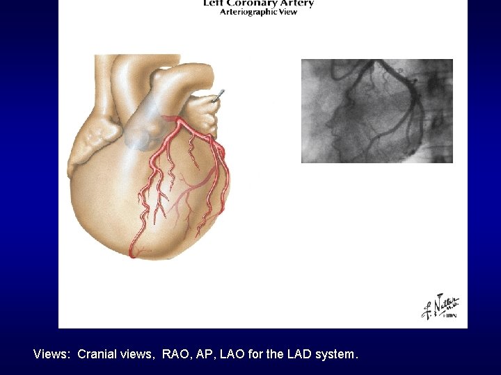 Views: Cranial views, RAO, AP, LAO for the LAD system. 