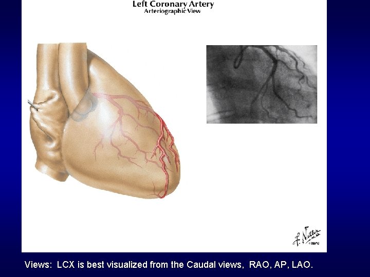 Views: LCX is best visualized from the Caudal views, RAO, AP, LAO. 
