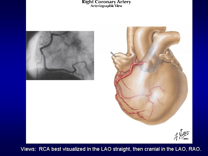 Views: RCA best visualized in the LAO straight, then cranial in the LAO, RAO.